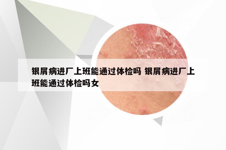 银屑病进厂上班能通过体检吗 银屑病进厂上班能通过体检吗女