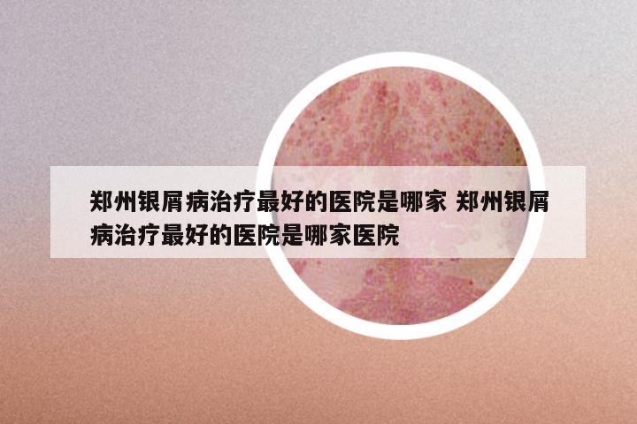 郑州银屑病治疗最好的医院是哪家 郑州银屑病治疗最好的医院是哪家医院