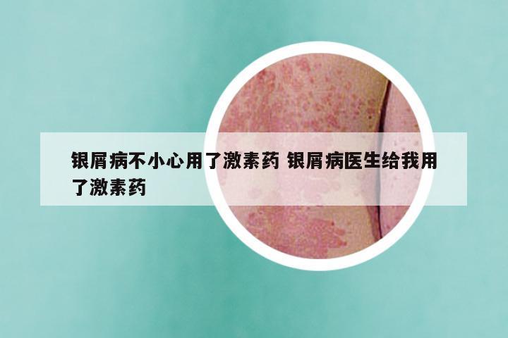 银屑病不小心用了激素药 银屑病医生给我用了激素药