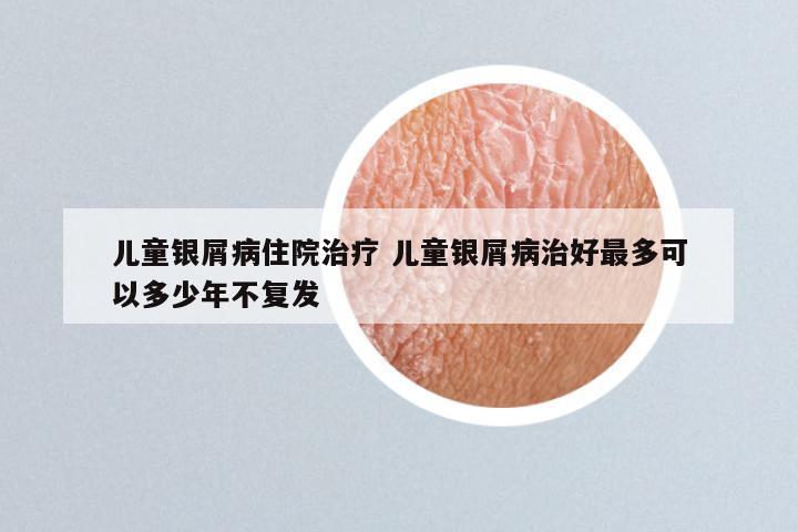 儿童银屑病住院治疗 儿童银屑病治好最多可以多少年不复发