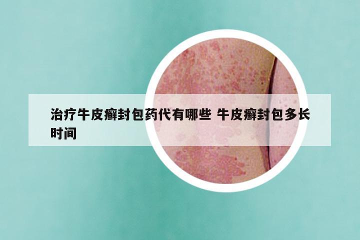 治疗牛皮癣封包药代有哪些 牛皮癣封包多长时间
