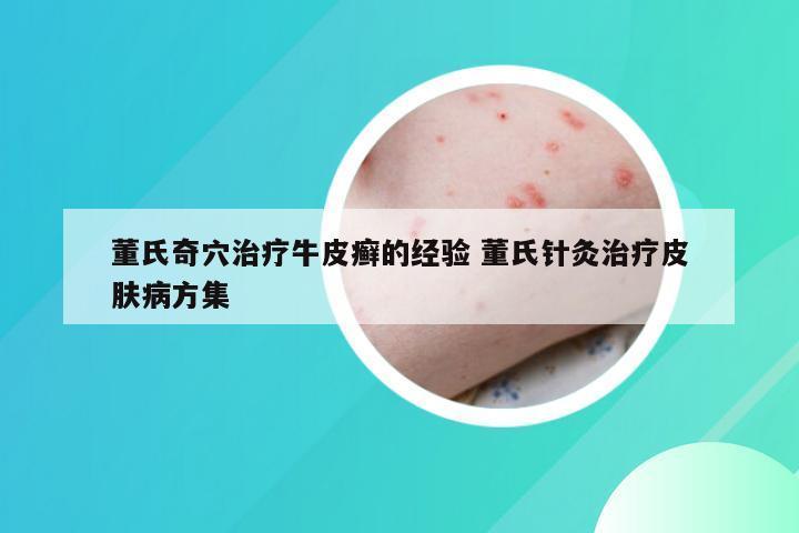 董氏奇穴治疗牛皮癣的经验 董氏针灸治疗皮肤病方集