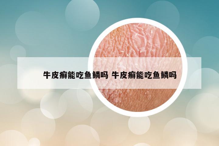 牛皮癣能吃鱼鳞吗 牛皮癣能吃鱼鳞吗
