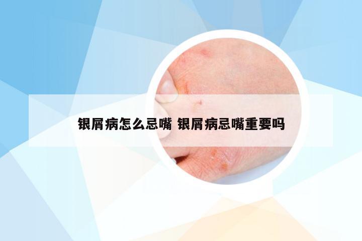 银屑病怎么忌嘴 银屑病忌嘴重要吗
