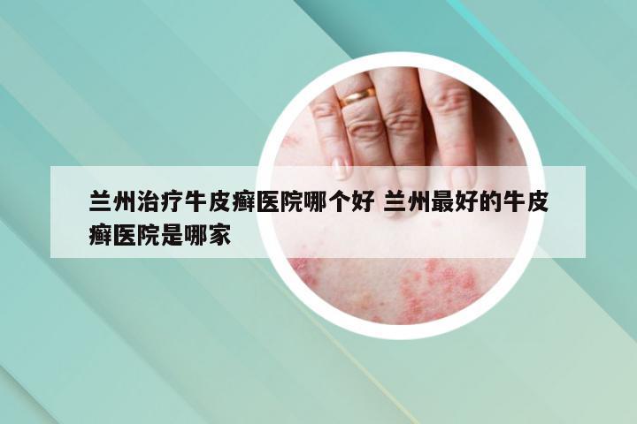 兰州治疗牛皮癣医院哪个好 兰州最好的牛皮癣医院是哪家