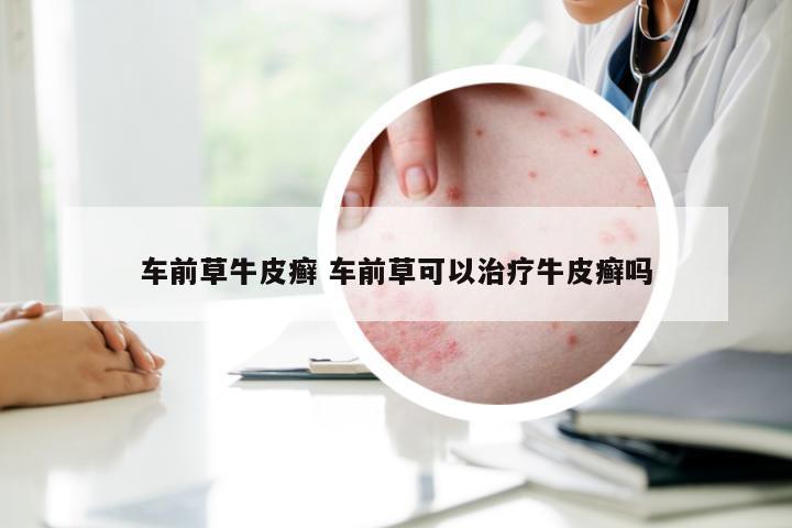车前草牛皮癣 车前草可以治疗牛皮癣吗