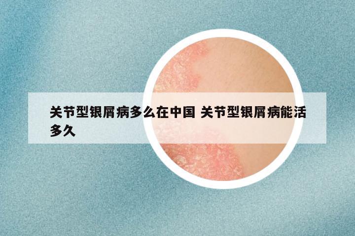 关节型银屑病多么在中国 关节型银屑病能活多久
