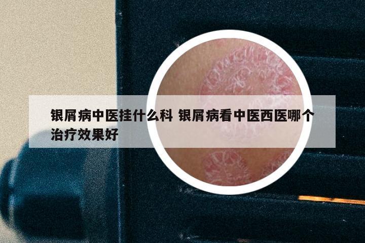 银屑病中医挂什么科 银屑病看中医西医哪个治疗效果好