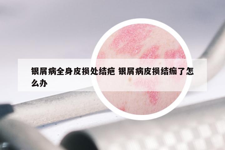 银屑病全身皮损处结疤 银屑病皮损结痂了怎么办