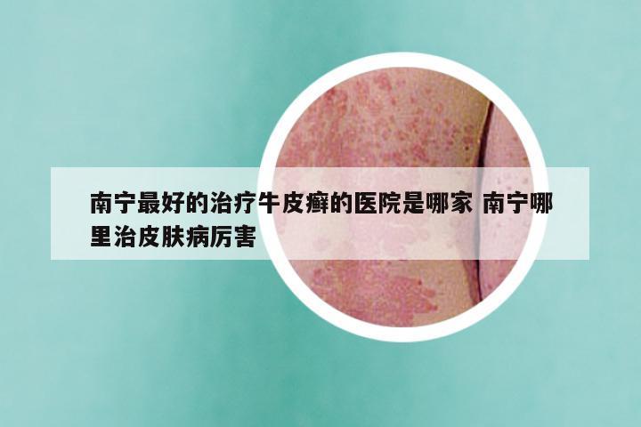 南宁最好的治疗牛皮癣的医院是哪家 南宁哪里治皮肤病厉害