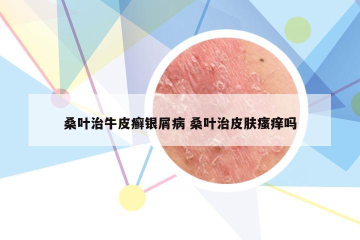 桑叶治牛皮癣银屑病 桑叶治皮肤瘙痒吗