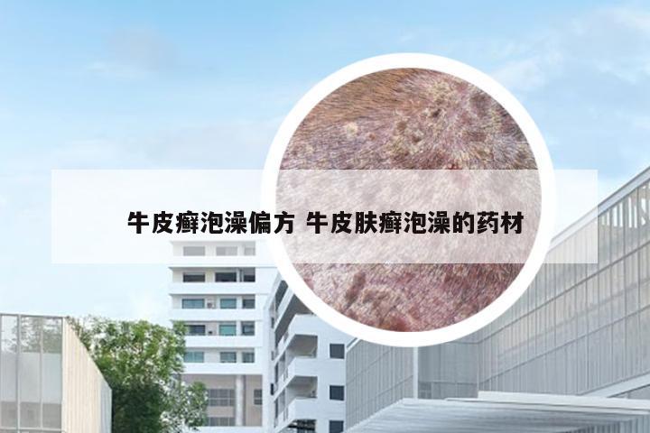 牛皮癣泡澡偏方 牛皮肤癣泡澡的药材
