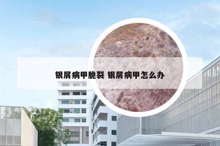 银屑病甲脆裂 银屑病甲怎么办