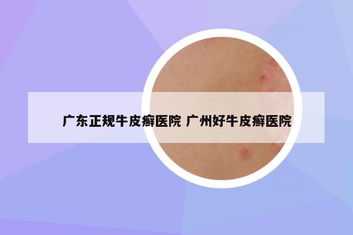 广东正规牛皮癣医院 广州好牛皮癣医院
