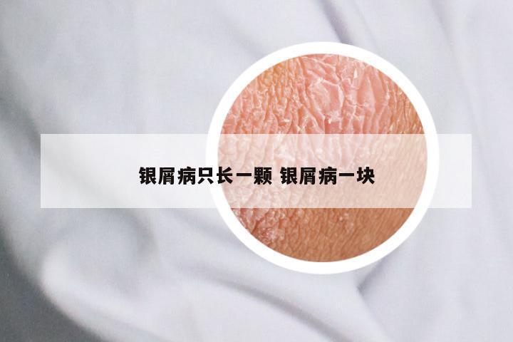 银屑病只长一颗 银屑病一块