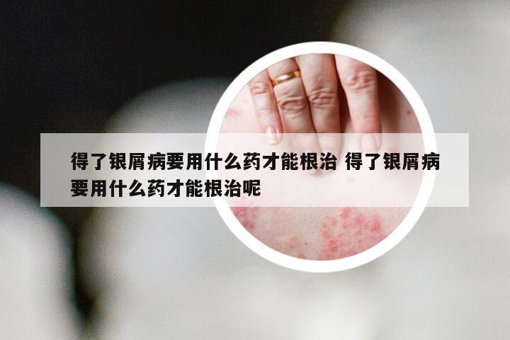 得了银屑病要用什么药才能根治 得了银屑病要用什么药才能根治呢