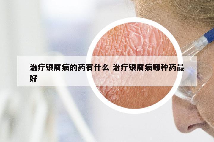 治疗银屑病的药有什么 治疗银屑病哪种药最好