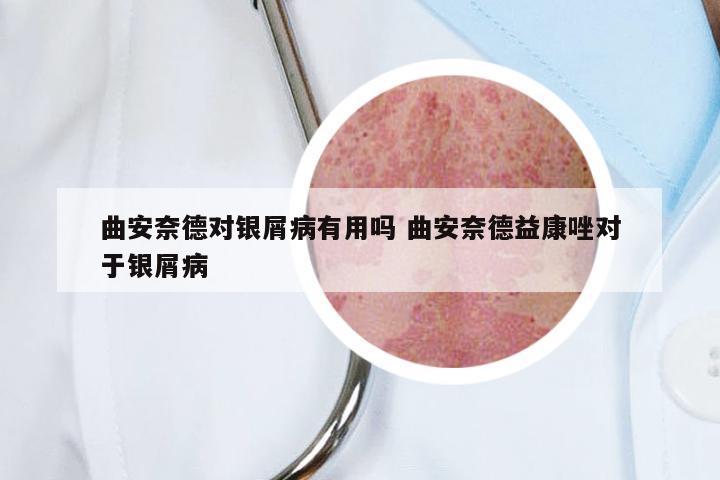 曲安奈德对银屑病有用吗 曲安奈德益康唑对于银屑病