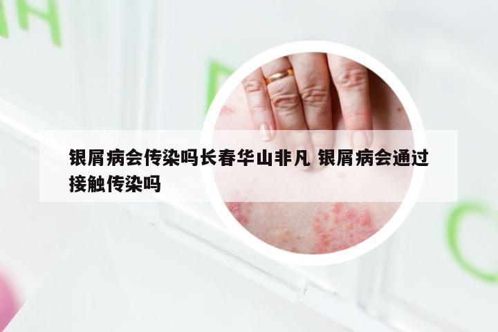银屑病会传染吗长春华山非凡 银屑病会通过接触传染吗