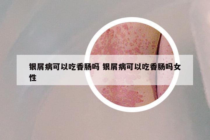 银屑病可以吃香肠吗 银屑病可以吃香肠吗女性