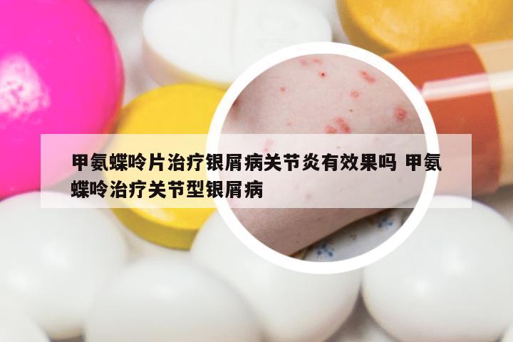 甲氨蝶呤片治疗银屑病关节炎有效果吗 甲氨蝶呤治疗关节型银屑病