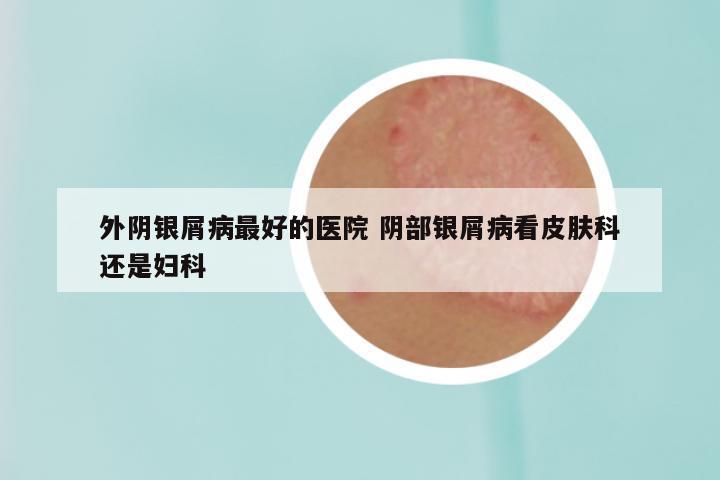 外阴银屑病最好的医院 阴部银屑病看皮肤科还是妇科
