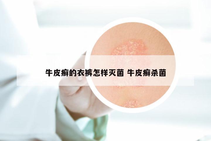 牛皮癣的衣裤怎样灭菌 牛皮癣杀菌