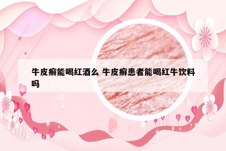 牛皮癣能喝红酒么 牛皮癣患者能喝红牛饮料吗