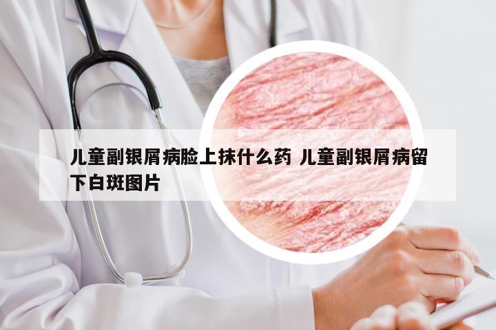 儿童副银屑病脸上抹什么药 儿童副银屑病留下白斑图片
