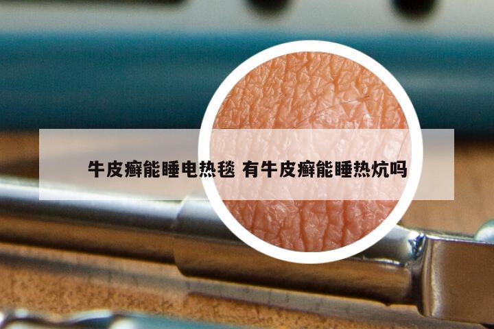 牛皮癣能睡电热毯 有牛皮癣能睡热炕吗