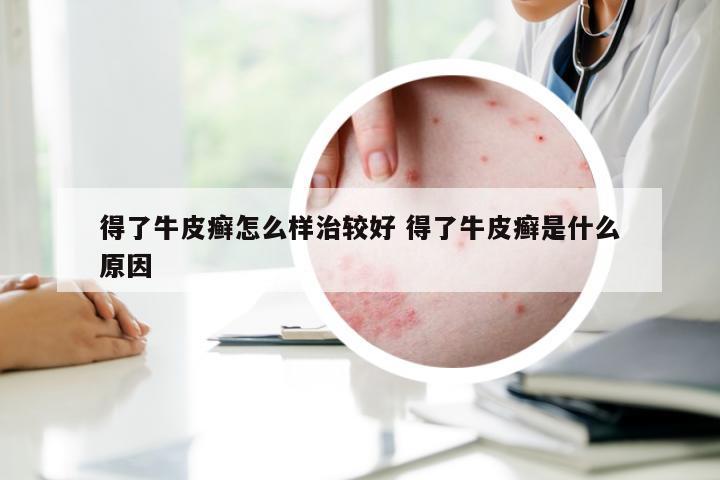 得了牛皮癣怎么样治较好 得了牛皮癣是什么原因