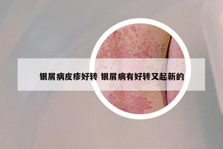 银屑病皮疹好转 银屑病有好转又起新的