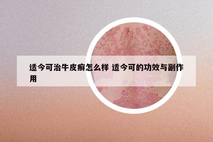 适今可治牛皮癣怎么样 适今可的功效与副作用