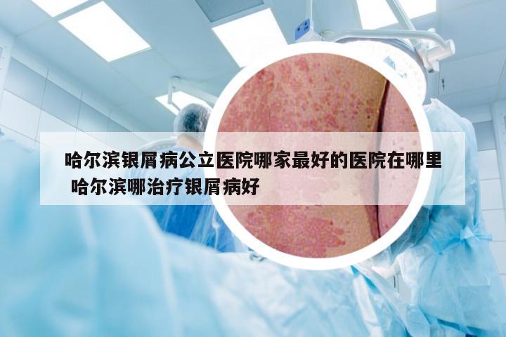 哈尔滨银屑病公立医院哪家最好的医院在哪里 哈尔滨哪治疗银屑病好