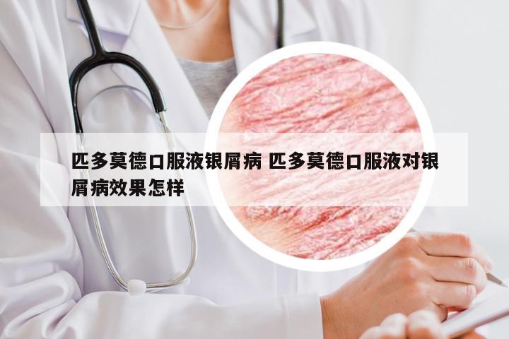 匹多莫德口服液银屑病 匹多莫德口服液对银屑病效果怎样