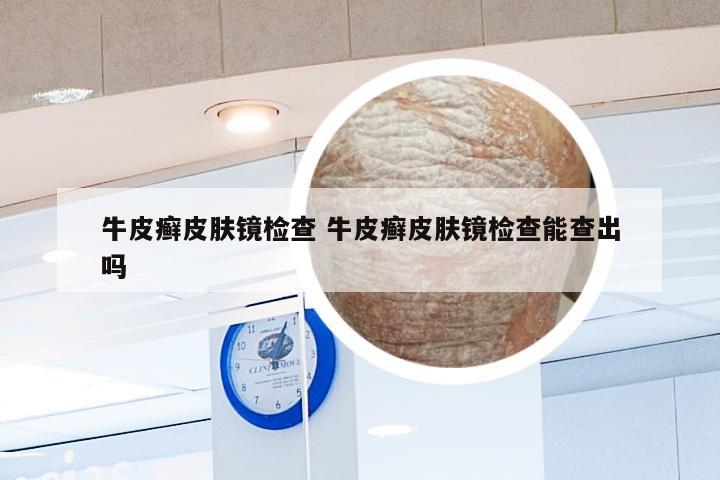牛皮癣皮肤镜检查 牛皮癣皮肤镜检查能查出吗