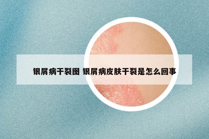 银屑病干裂图 银屑病皮肤干裂是怎么回事