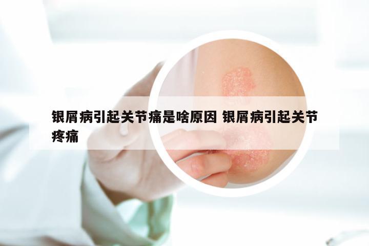 银屑病引起关节痛是啥原因 银屑病引起关节疼痛
