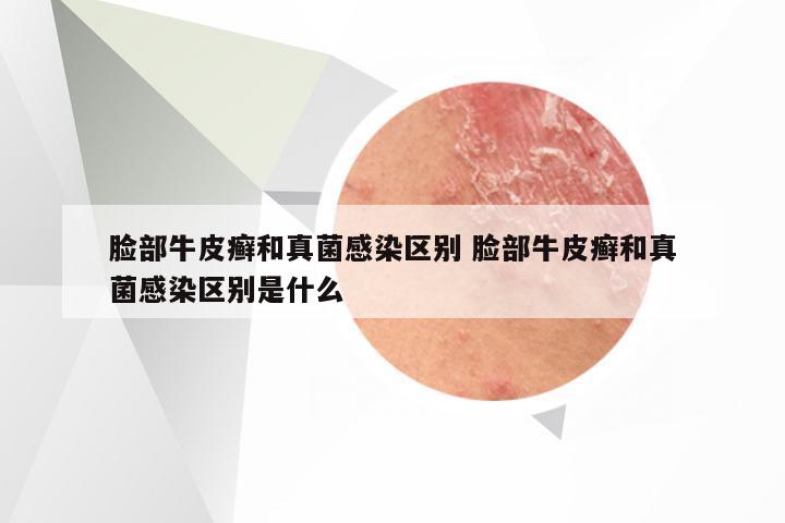 脸部牛皮癣和真菌感染区别 脸部牛皮癣和真菌感染区别是什么