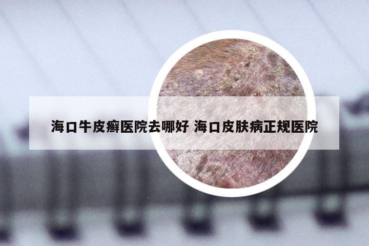 海口牛皮癣医院去哪好 海口皮肤病正规医院