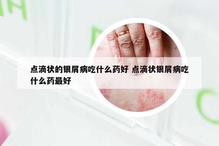 点滴状的银屑病吃什么药好 点滴状银屑病吃什么药最好