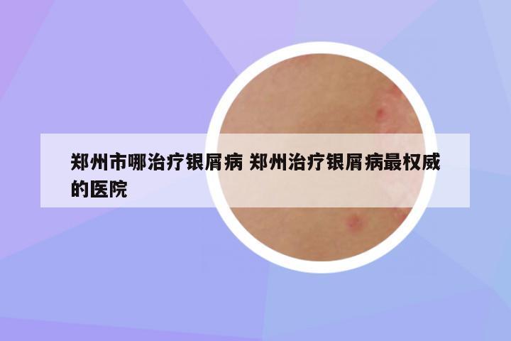 郑州市哪治疗银屑病 郑州治疗银屑病最权威的医院