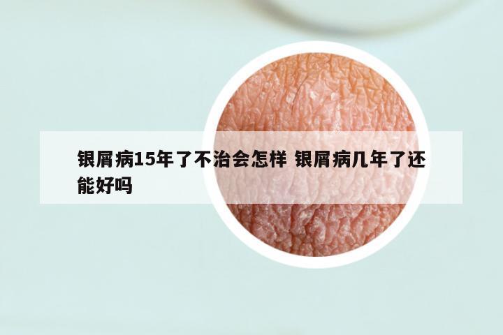 银屑病15年了不治会怎样 银屑病几年了还能好吗