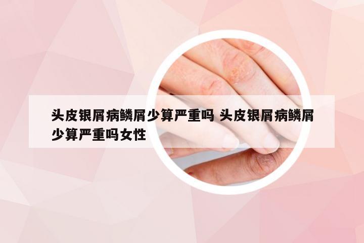 头皮银屑病鳞屑少算严重吗 头皮银屑病鳞屑少算严重吗女性