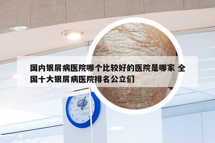 国内银屑病医院哪个比较好的医院是哪家 全国十大银屑病医院排名公立们