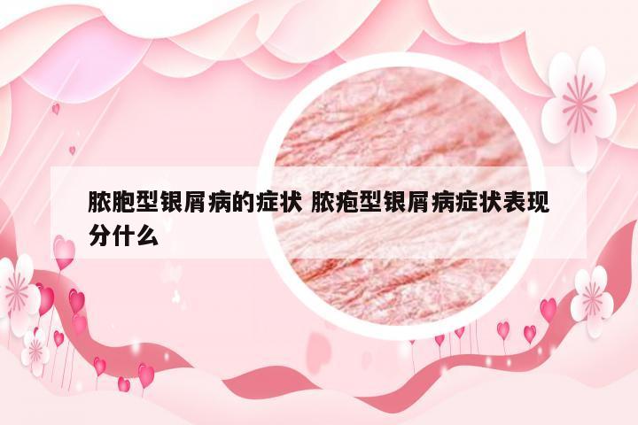 脓胞型银屑病的症状 脓疱型银屑病症状表现分什么