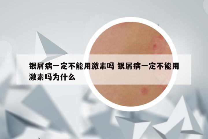 银屑病一定不能用激素吗 银屑病一定不能用激素吗为什么