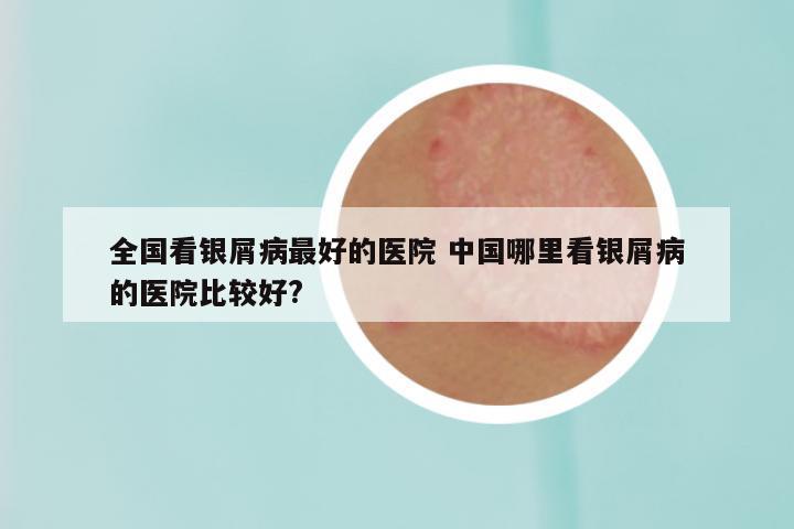 全国看银屑病最好的医院 中国哪里看银屑病的医院比较好?