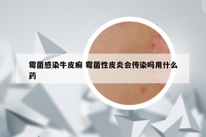 霉菌感染牛皮癣 霉菌性皮炎会传染吗用什么药