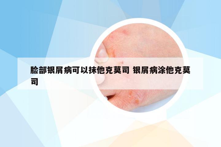 脸部银屑病可以抹他克莫司 银屑病涂他克莫司